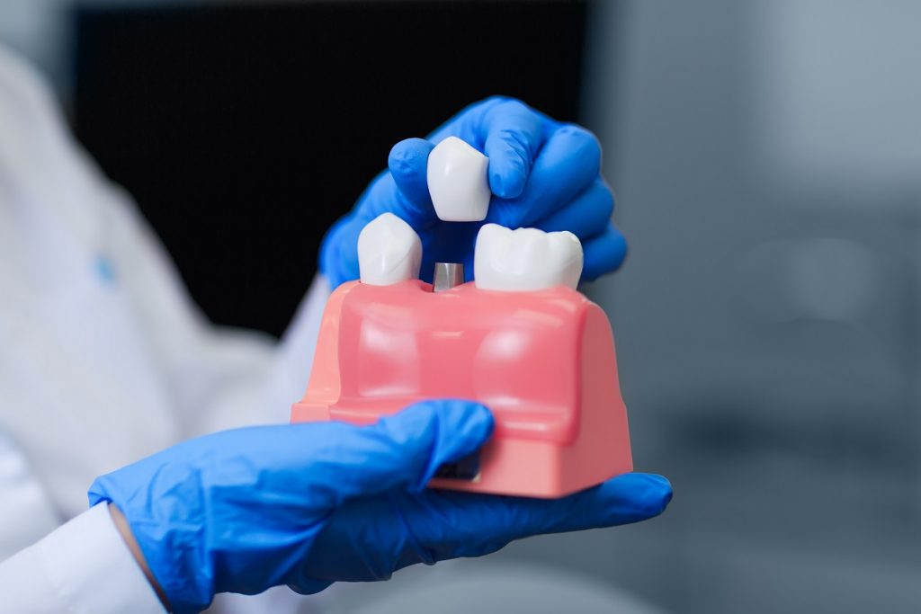 Dental implant teeth model