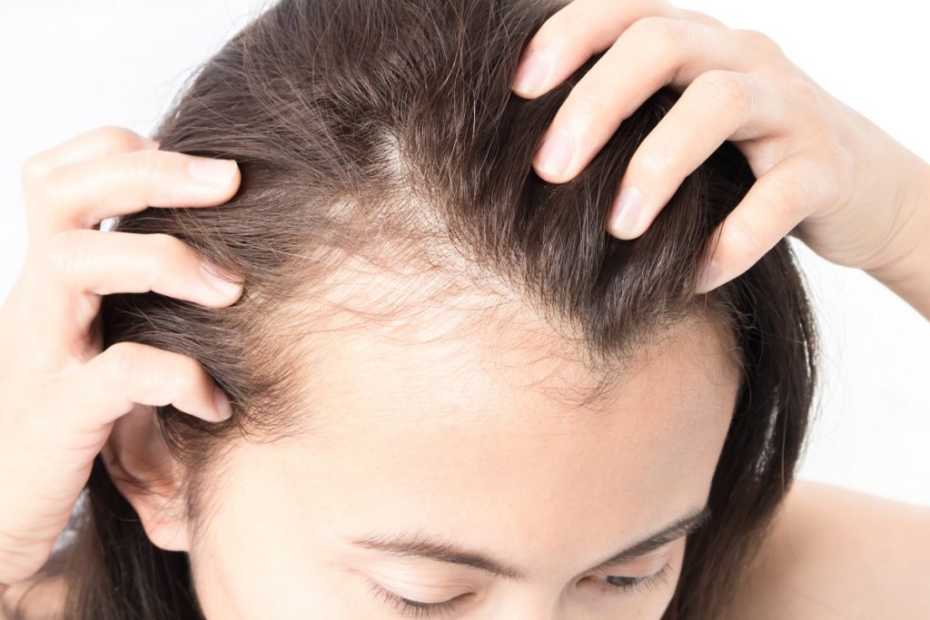 Woman showing her area of hair loss