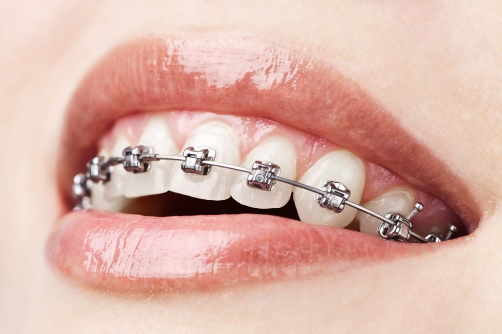Close up photo of a woman with braces