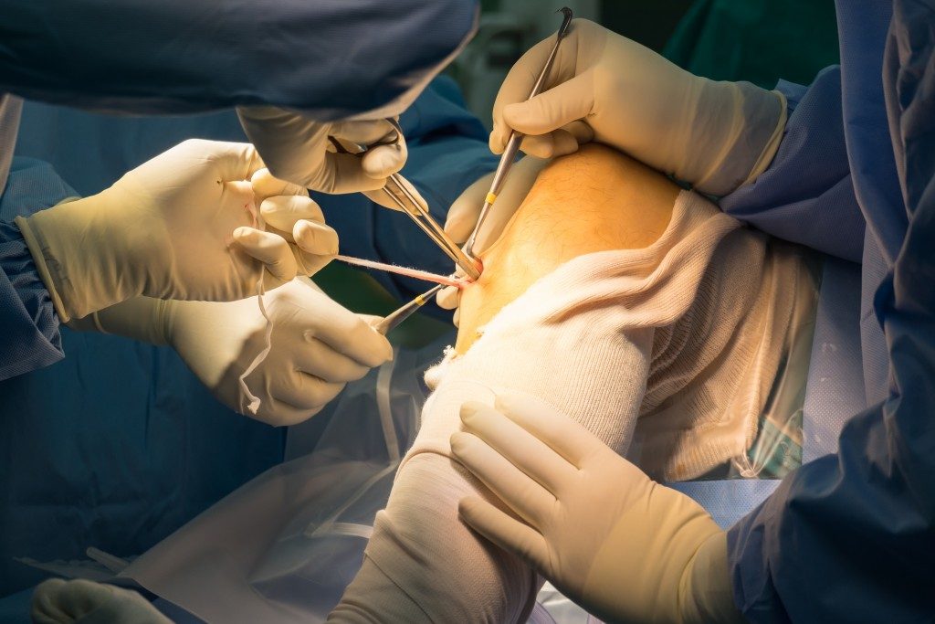 ACL Surgery