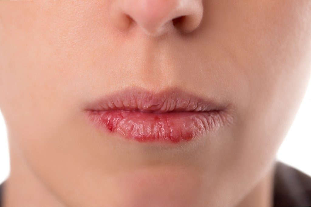 Closeup womans face with brittle and dry lips, concept lip salve and wounds