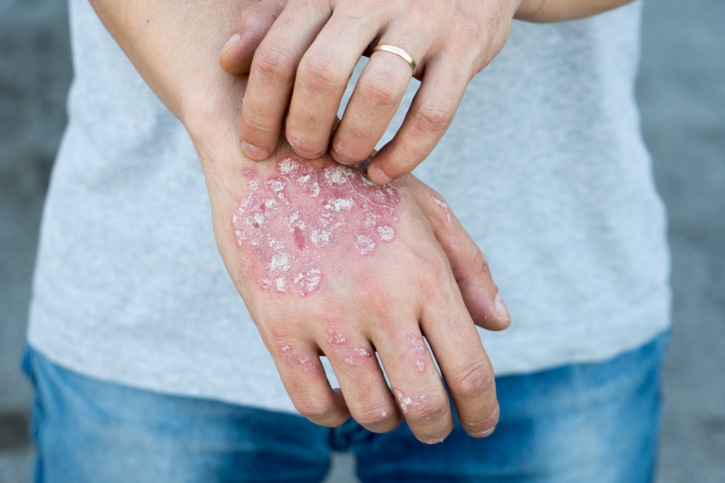 Dry flaky skin on hand with psoriasis vulgaris